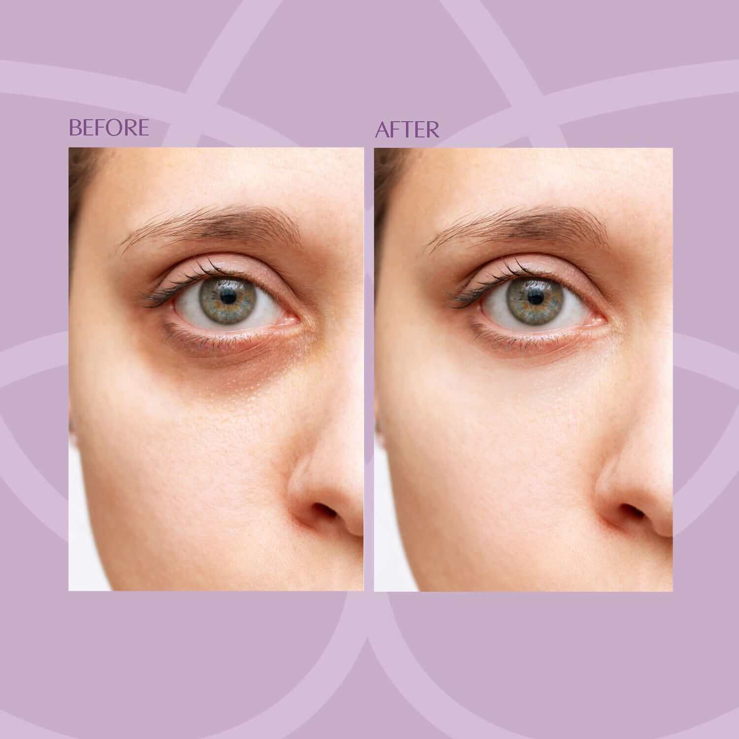 Before and after under-eye results with DCX Eye Treatment