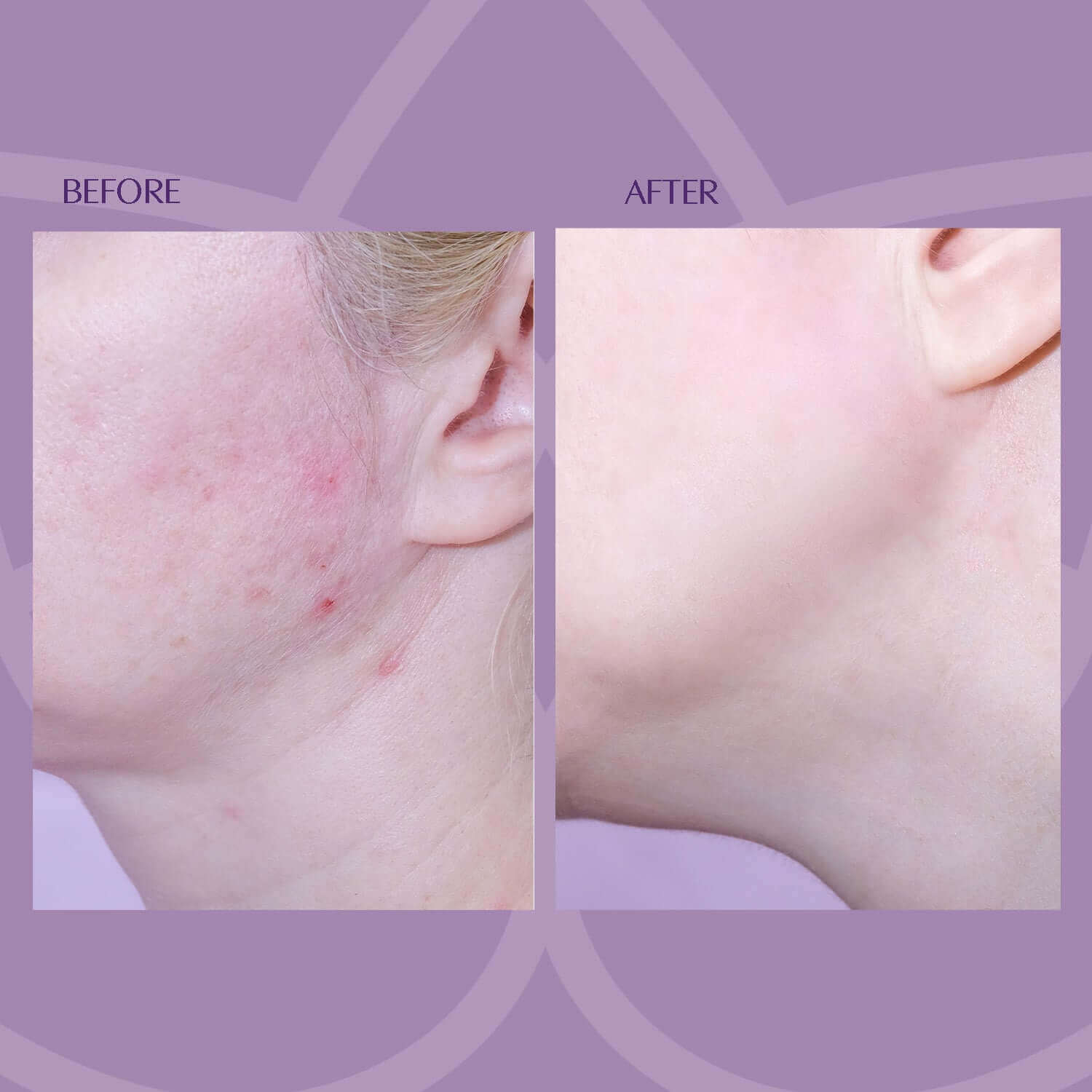 Before and after skin results with Liquid Platinum Fruit Acid Peel